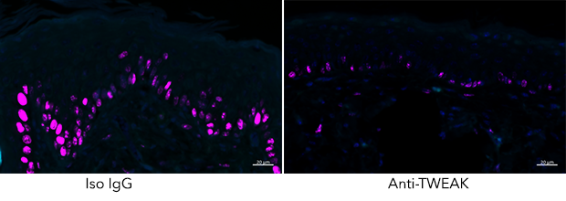 The Croft Lab captured how the proliferation of skin cells, as seen in psoriasis (indicated with purple staining), decreased when TWEAK activity was blocked (Image courtesy Rinkesh Gupta.)