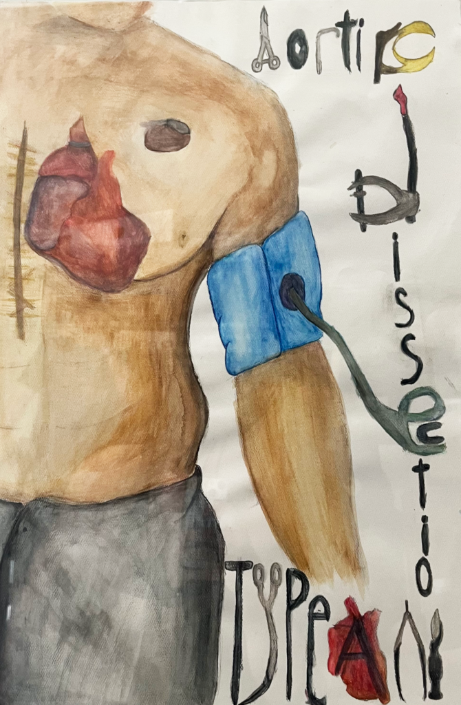 Painting of the side of a man with no shirt. We see a scar on his chest and a red heart through his body. The words "Aortic Dissection Type A" are spelled out using surgical tools.