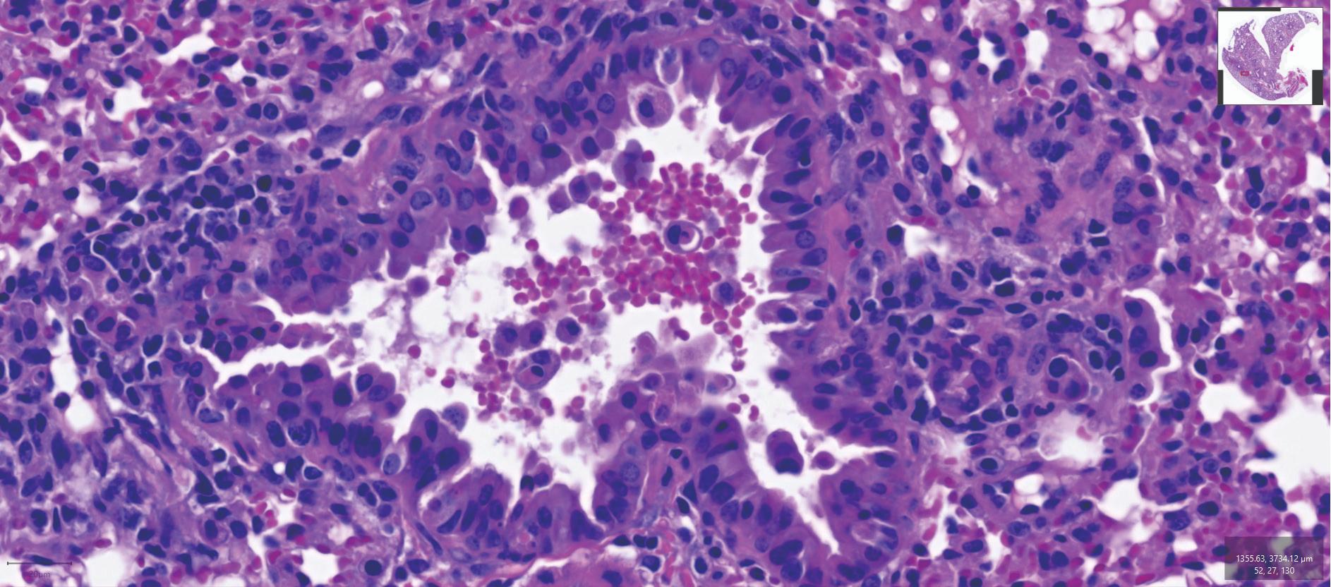 Lung Bronchiole Phagocytosis