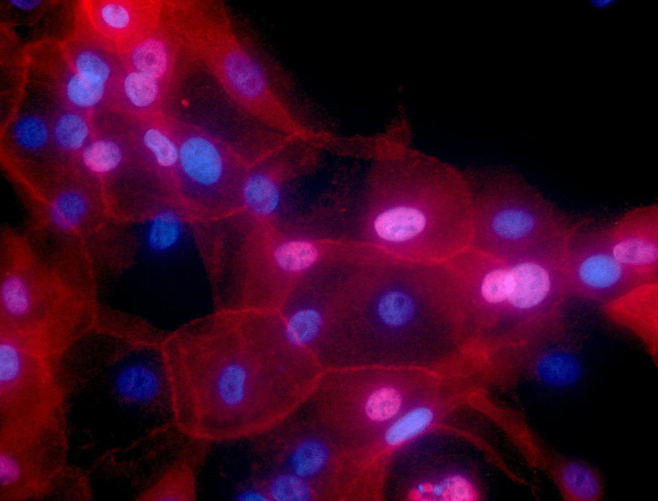: Image of breast cancer cells. Provided by the National Cancer Institute's Cancer Close Up project.
