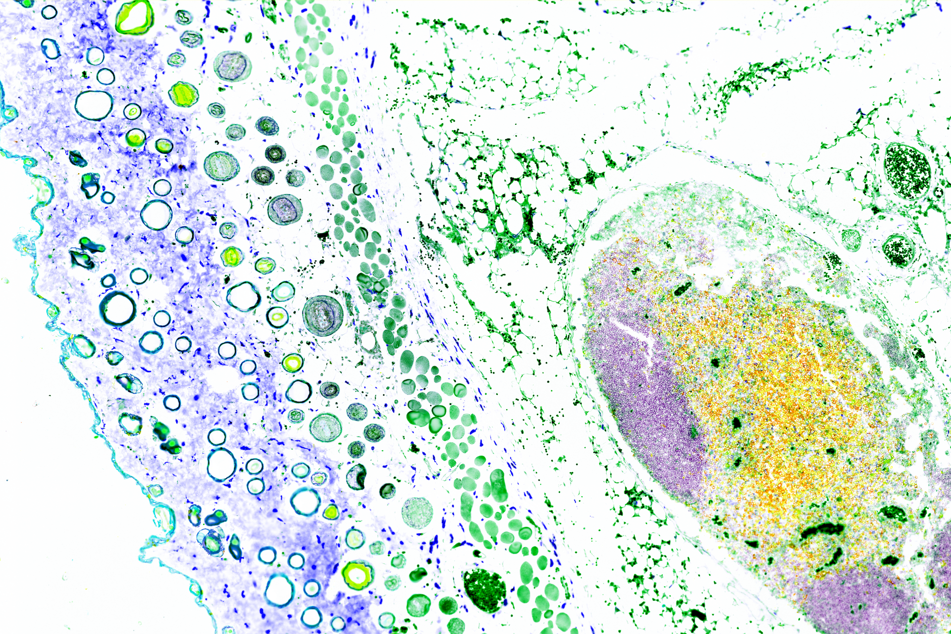 This image shows the layers of protection built into our skin. The top layer of skin cells (light blue) is followed by a thicker network of collagen bers (purple) with macrophages (dark blue). Ovals of hair follicles and sweat glands make their appearance, just above the layer of muscles (green). Underneath, cozy in a layer of fat sits a large lymph node, packed with B cells (purple) and T cells  (yellow and orange). This strategic location helps to protect us from bacteria, viruses, and vector- transmitted diseases such as Zika, Dengue, and Chikungunya viruses.