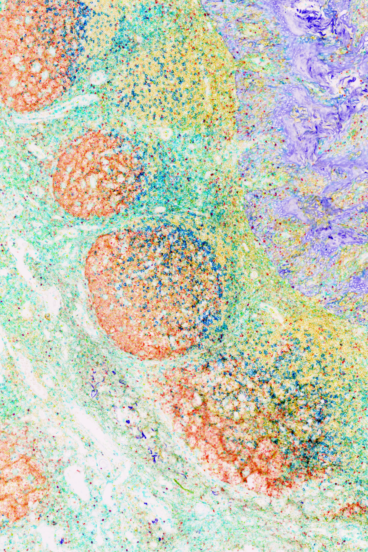 This human tonsil shows a heightened state of immune activation. The orange orbs are germinal centers—places where B cells multiply and compete to become better antibody producers. They get help from the follicular T helper cells (blue) and are surrounded by a mesh of other immune cells. Take a closer look at blue cells with red centers: they are regulatory T cells. Fuchsia-stained cells on the right are lining the dome of the tonsil. The proper functioning of these immune cells guards us against pathogens, autoimmune diseases, and cancers.