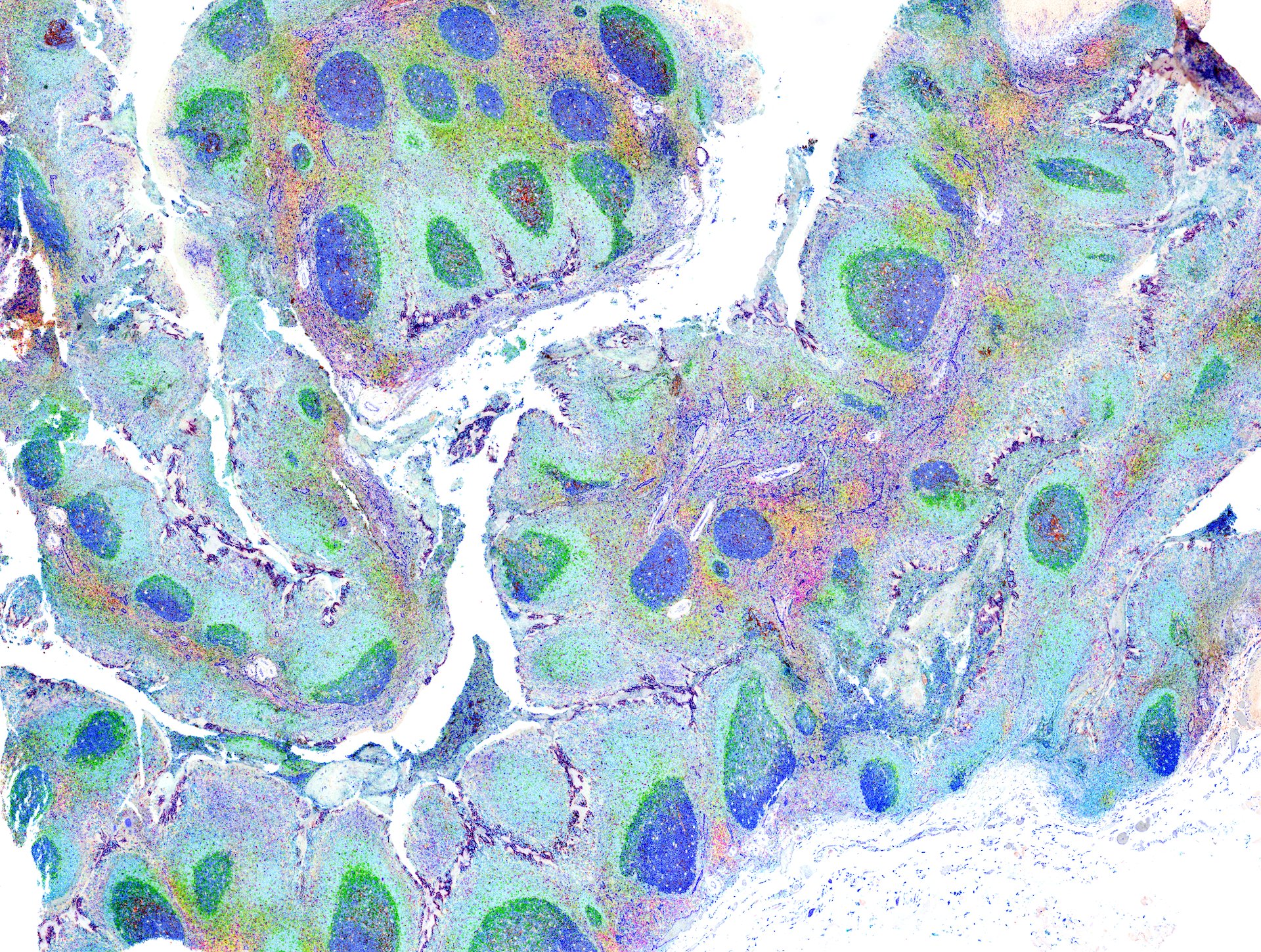 The egg-shaped structures seen in this fragment of the human palate are lymphoid follicles—places where germinal centers form to shape the antibody immune response. Each color signies a dierent marker of immune cells and the structures that support them. This new technology called multiplexing allows us to paint the landscapes of diseases and normal tissues with a stunning pallet of 17 colors.